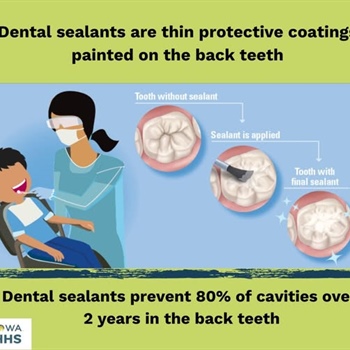 🦷 Dental Sealants: A Simple Way to Protect Smiles 🦷